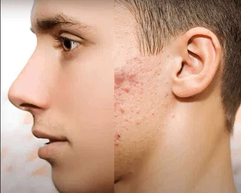 5 ways to remove skin blemishes in Photoshop